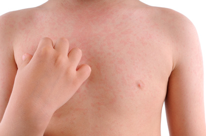 Histamine, Mast Cells and Methylation: A Mother Battles MCAD