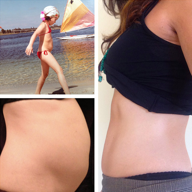 “Leaky gut” stomach before and after…